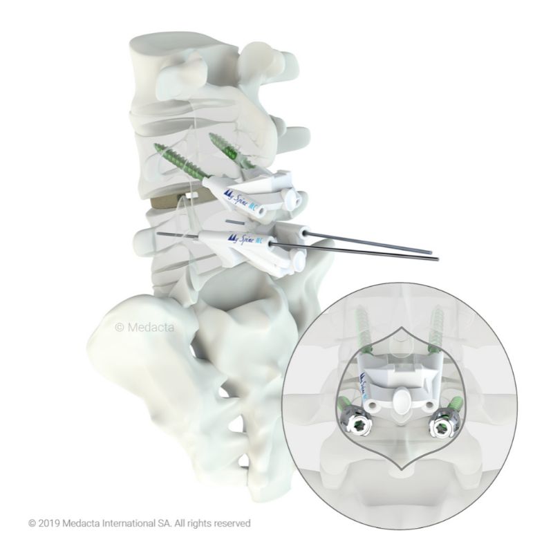 Medacta MySpine hoofdafbeelding (1)