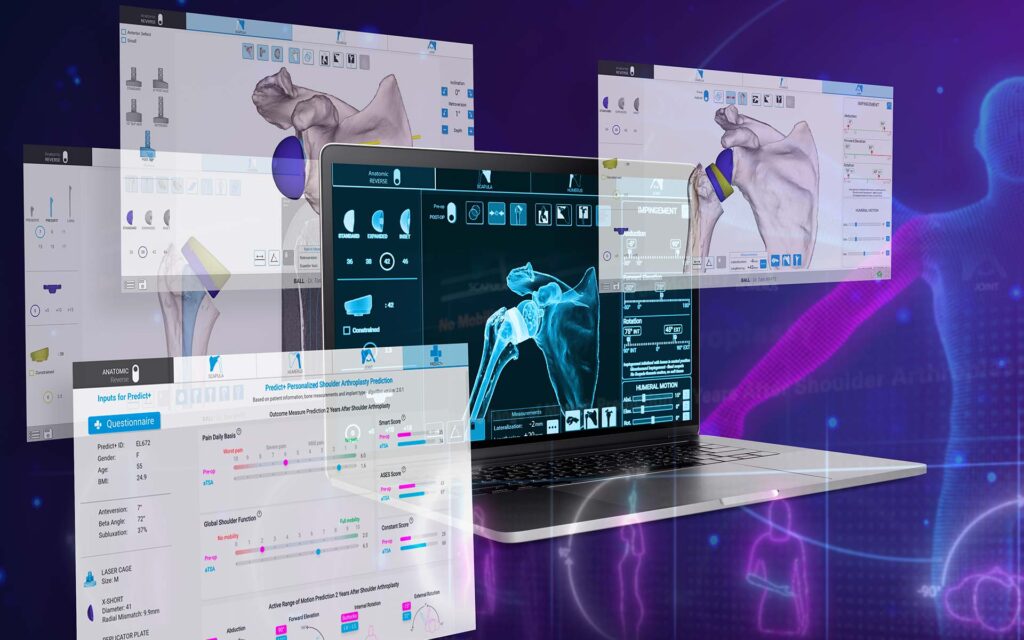 Shoulder planning app exactech schouder chirurgie